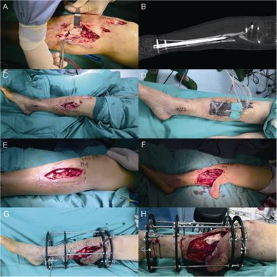 Masquelet technique with radical debridement and alternative fixation in treatment of infected bone nonunion